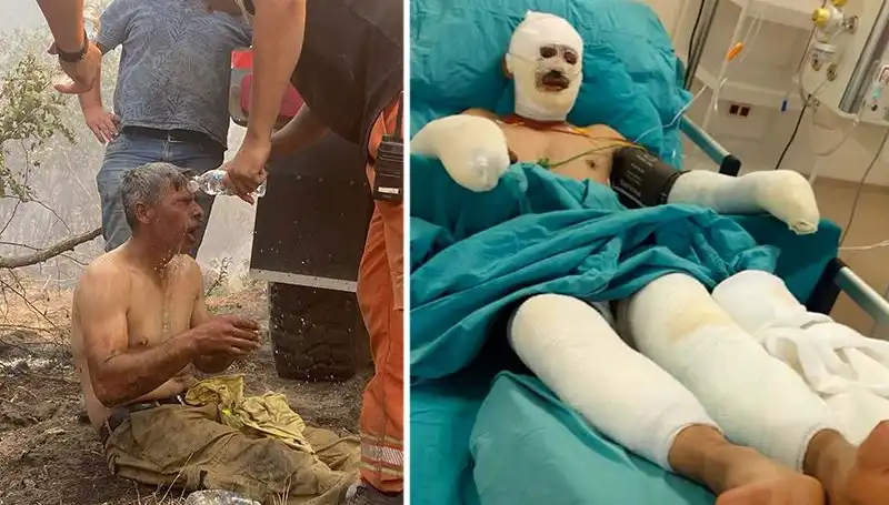 Orman İşçisinin "Yanıyorum" Feryadı, Tedavi Süreci Devam Ediyor!