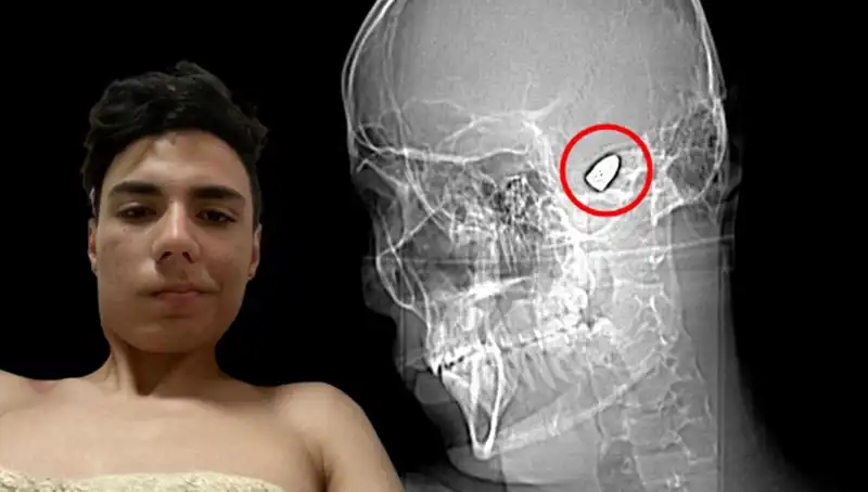 Hayatının Sonuna Gelmiş Gibi Hissediyor: Kafasında Patlayan Bomba İle Yaşamak