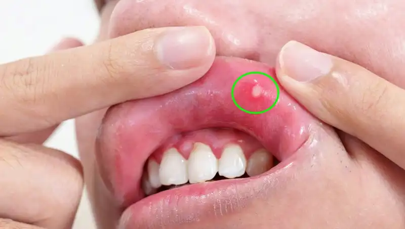 Vücudunuzda B Vitaminleri Eksikse Bu Belirtilere Dikkat Edin!