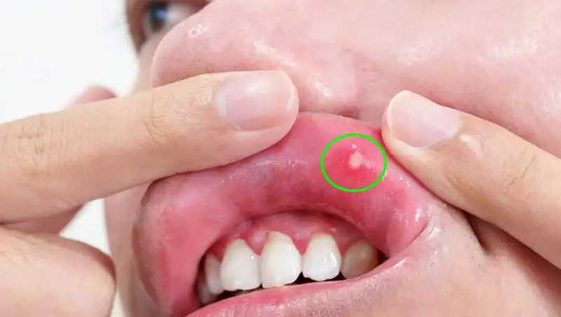 Kanserin Belirtilerini Göz Ardı Eden Kadına Şok Tedavi Uygulandı