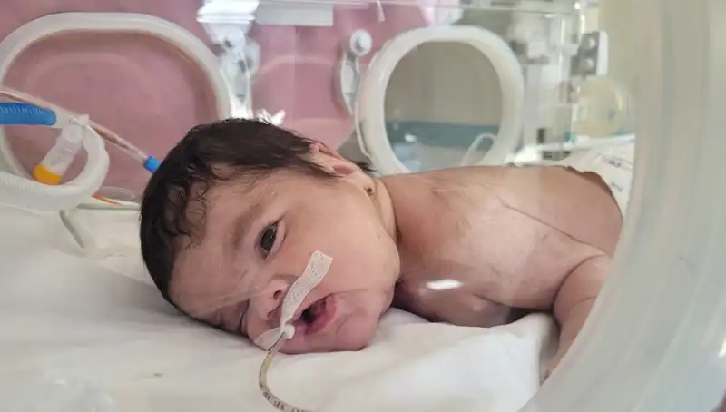 34 Haftalık Eymen Bebeğe Uygulanan Medikal Müdahale Dünyayı Şaşkına Çevirdi